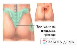 Пролежни между ягодицами у взрослых