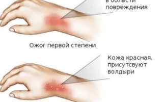 Что делать при ожоге 2 степени огнем