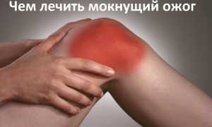 Средство от ожогов и мокнущих ран