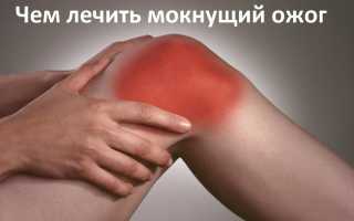 Средство от ожогов и мокнущих ран