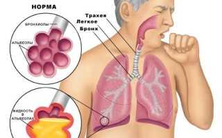 Пневмония средней степени тяжести лечение