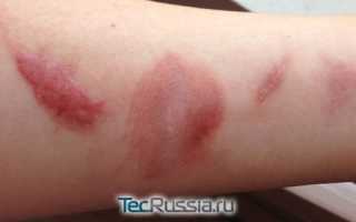 Мазь при шрамах при ожоге
