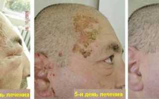 Стелланин инструкция по применению при ожогах