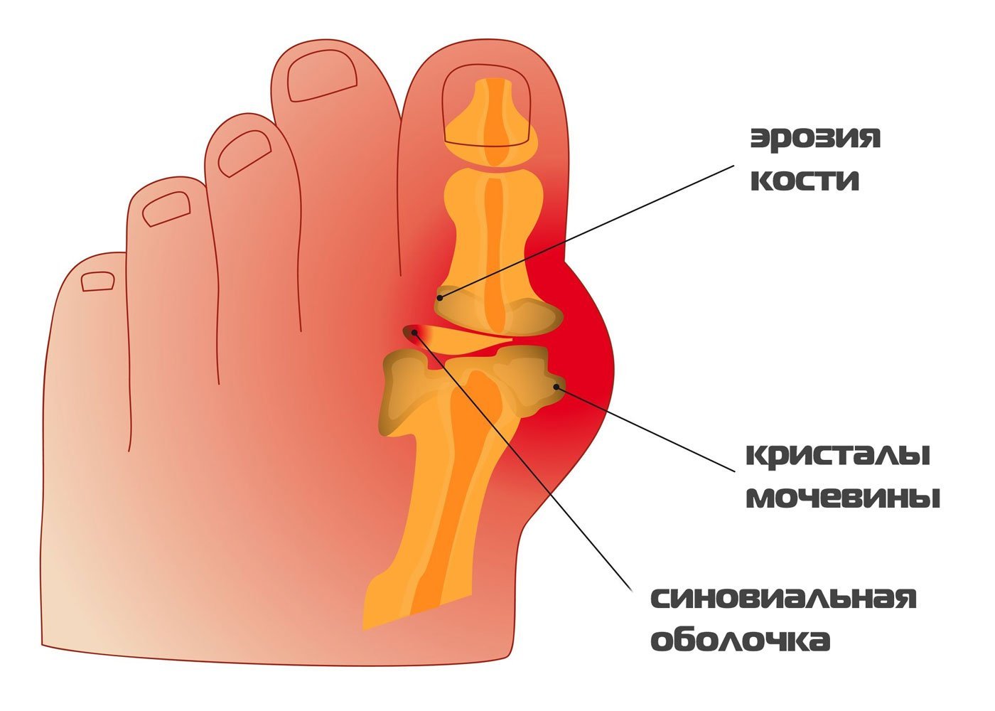 Свекла польза и вред при подагре