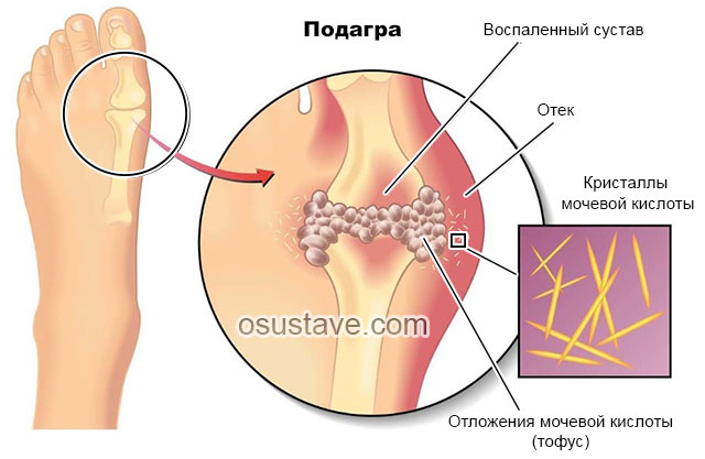 подагра