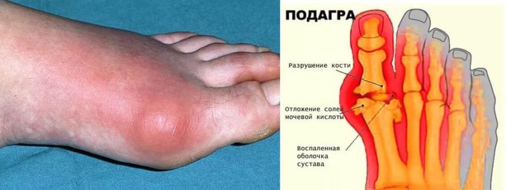 Куда ставят пиявки при подагре
