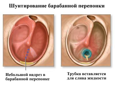 Шунтирование барабанной перепонки при отите