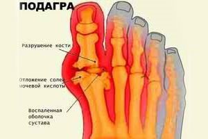 Подагра ног