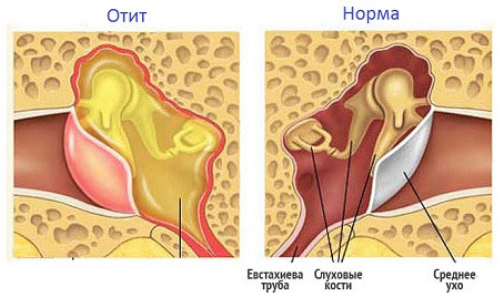 Почему при отите болит одно и то же ухо