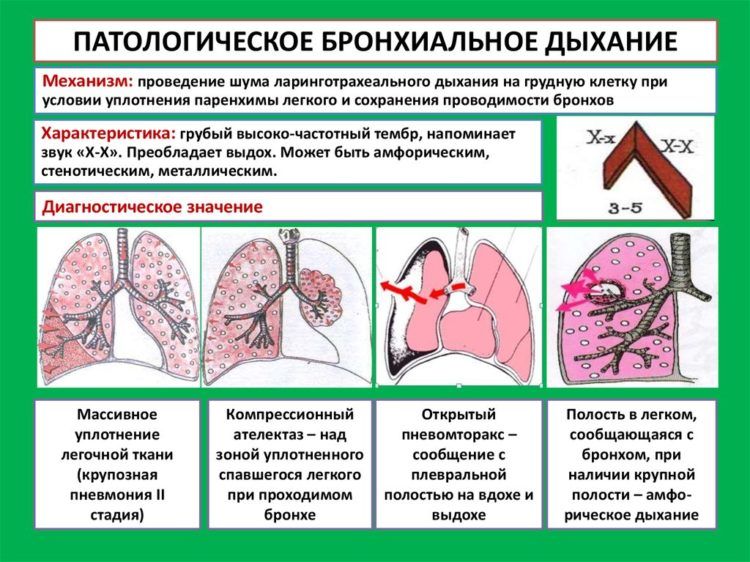 Патологическое бронхиальное дыхание
