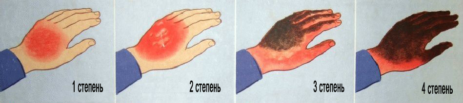 obzhegla-palets-kak-snjat-bol