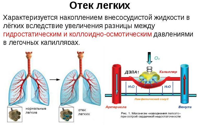 Пневмония может привести к отеку легких