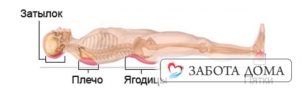 Зоны пролежней