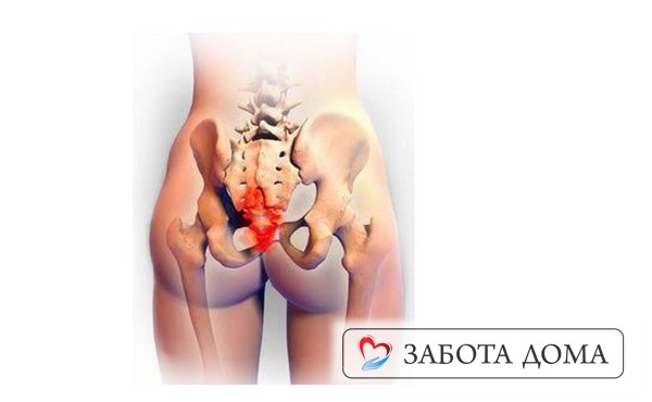 Пролежень на копчике