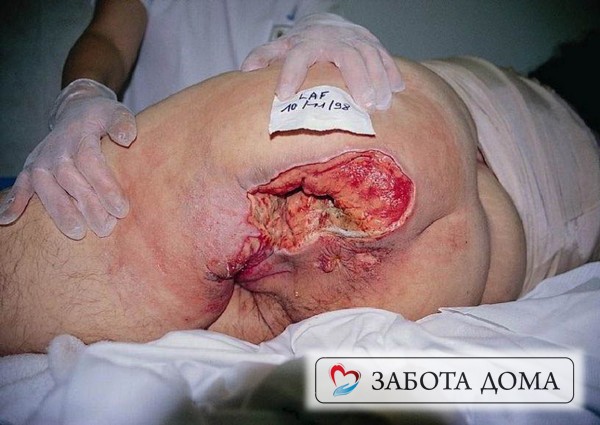 Пролежень на ягодицах