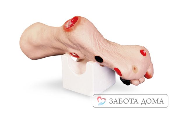 Пролежни на пятках