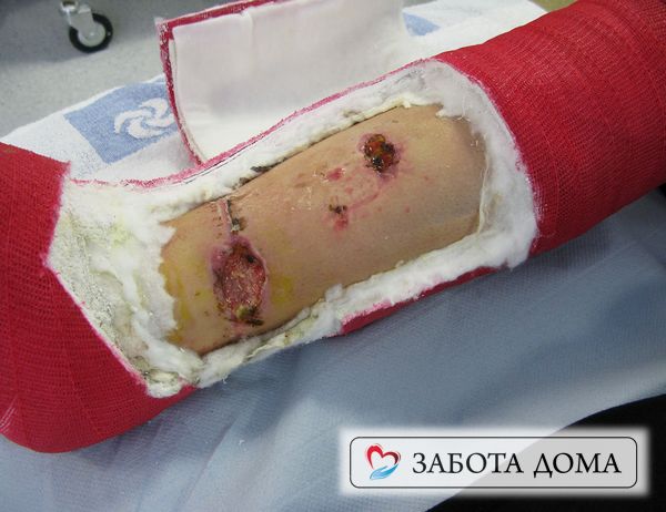 Окно для раны в гипсе