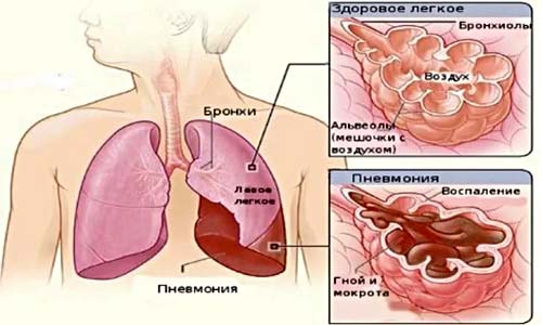 Как отличить бронхит от пневмонии у детей