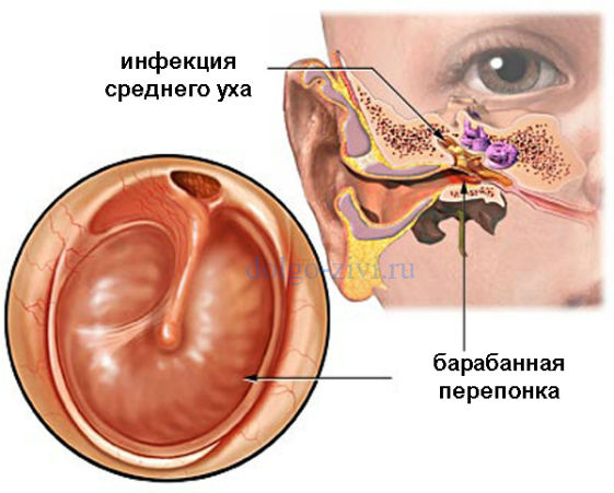 Можно ли вылечить хронический средний отит