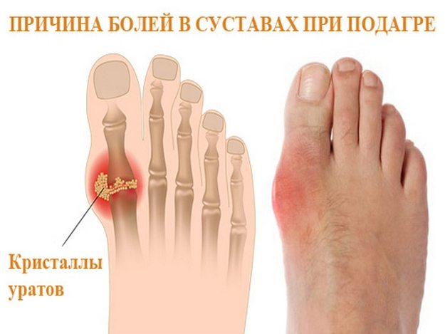 Подагра