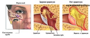 Лечение отита уха