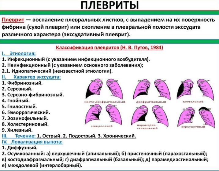 Плеврит