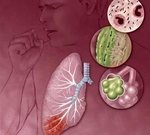 pneumonia