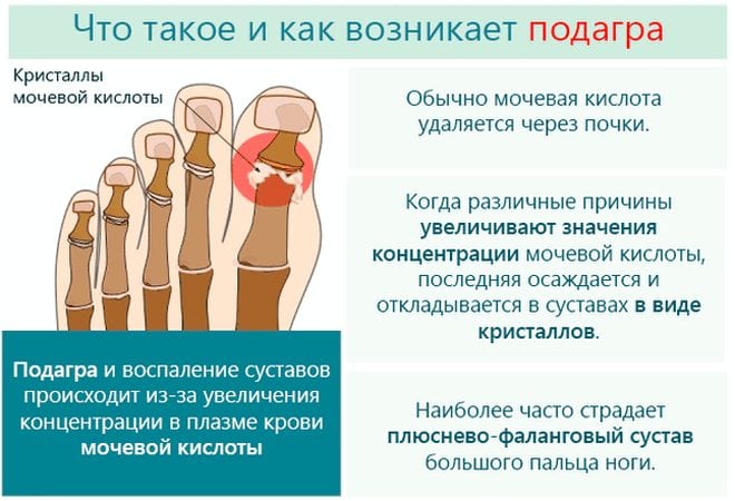 Как убрать подагру на ногах