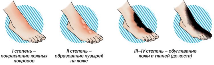 Ожог кипятком с волдырями лечение