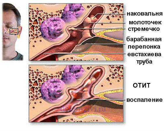 Можно ли вылечить хронический средний отит