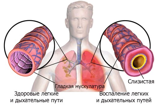 Затруднение дыхания обусловлено и сужением бронхов.